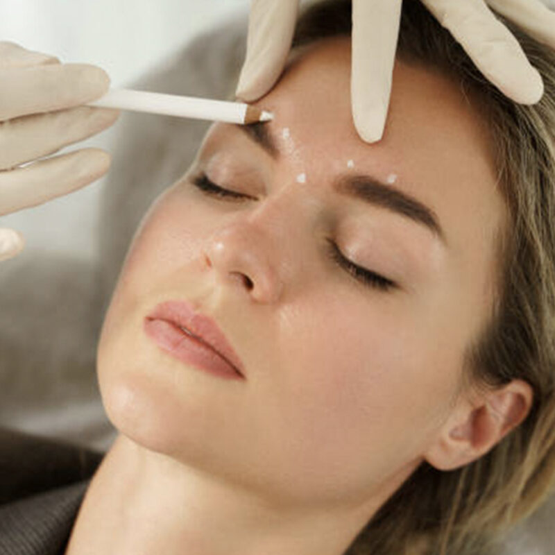 Botox Epsom Downs treatment areas