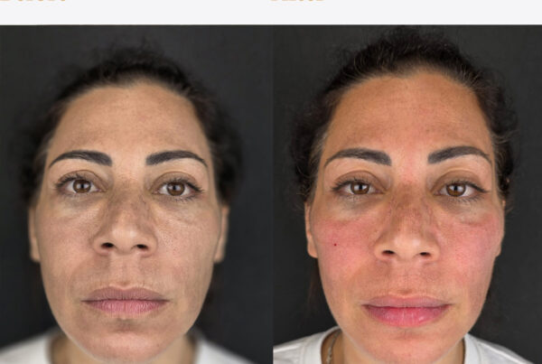 Cheek fillers Epsom Downs at Epitomi Aesthetics