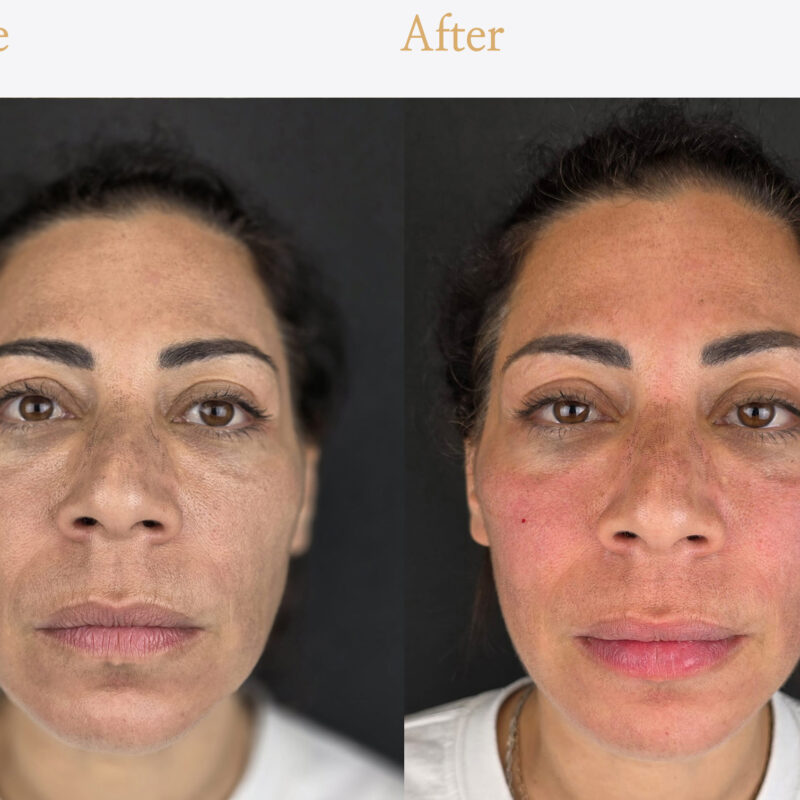 Cheek fillers Epsom Downs at Epitomi Aesthetics