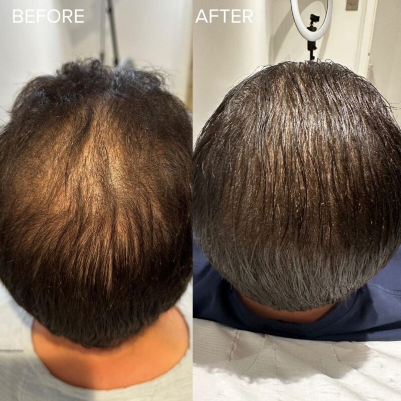 Polynucleotides for Hair Loss