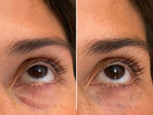 polynucleotides under eyes at Epitomi Aesthetics Epsom By Dr Effie