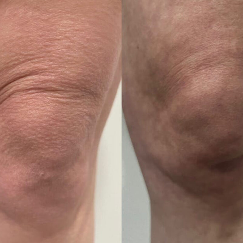 polynucleotides treatment in Epsom at Epitomi Aesthetics with Dr Effie