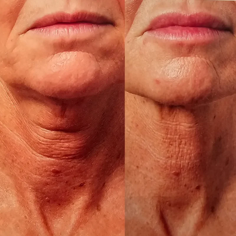 Loose neck skin treatment with Profhilo epsom downs at Epitomi