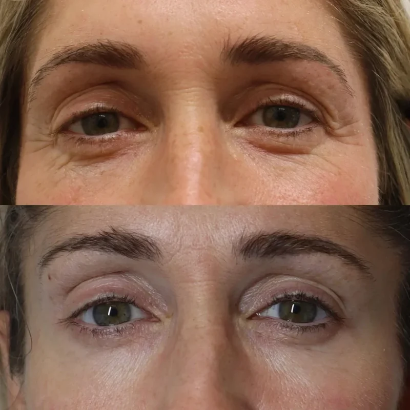 NeoGen Plasma Eye Lift Before and After - Epsom Downs