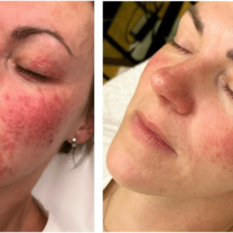 Plasma Skin Treatments