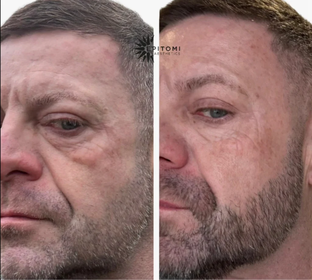 NeoGen Plasma Before and after results. 