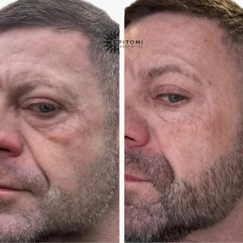 NeoGen Plasma Before and after results.