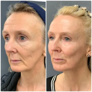NeoGen plasma eye lift Epsom Downs