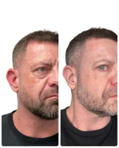 Neogen Plasma eye lift before and after - Epsom Downs