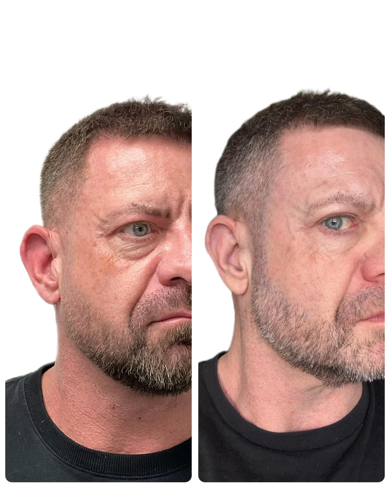 Plasma Eye Lift in Epsom: NeoGen Eye Lift Explained by Dr Effie